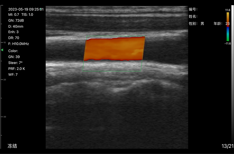 Doppler Color · Vascular lineal