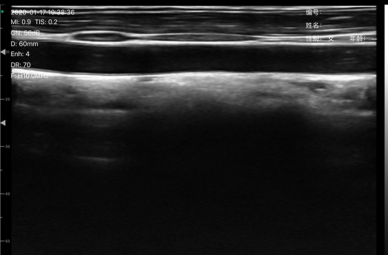 Vascular lineal